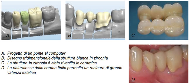 Protesi-fissa 1