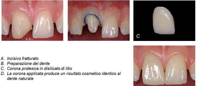 corone-estetiche