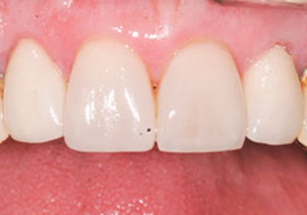 Corone estetiche metal-free in disilicato di litio