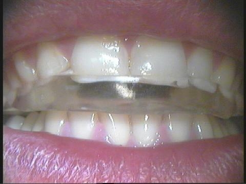 Bite: l'apparecchio che salva il sorriso