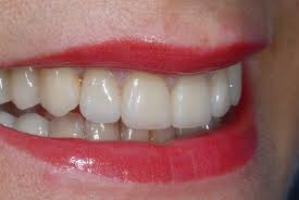 Protesi fissa metal-free in zirconia