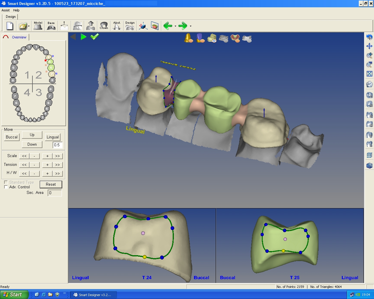 Protesi fissa in CAD-CAM