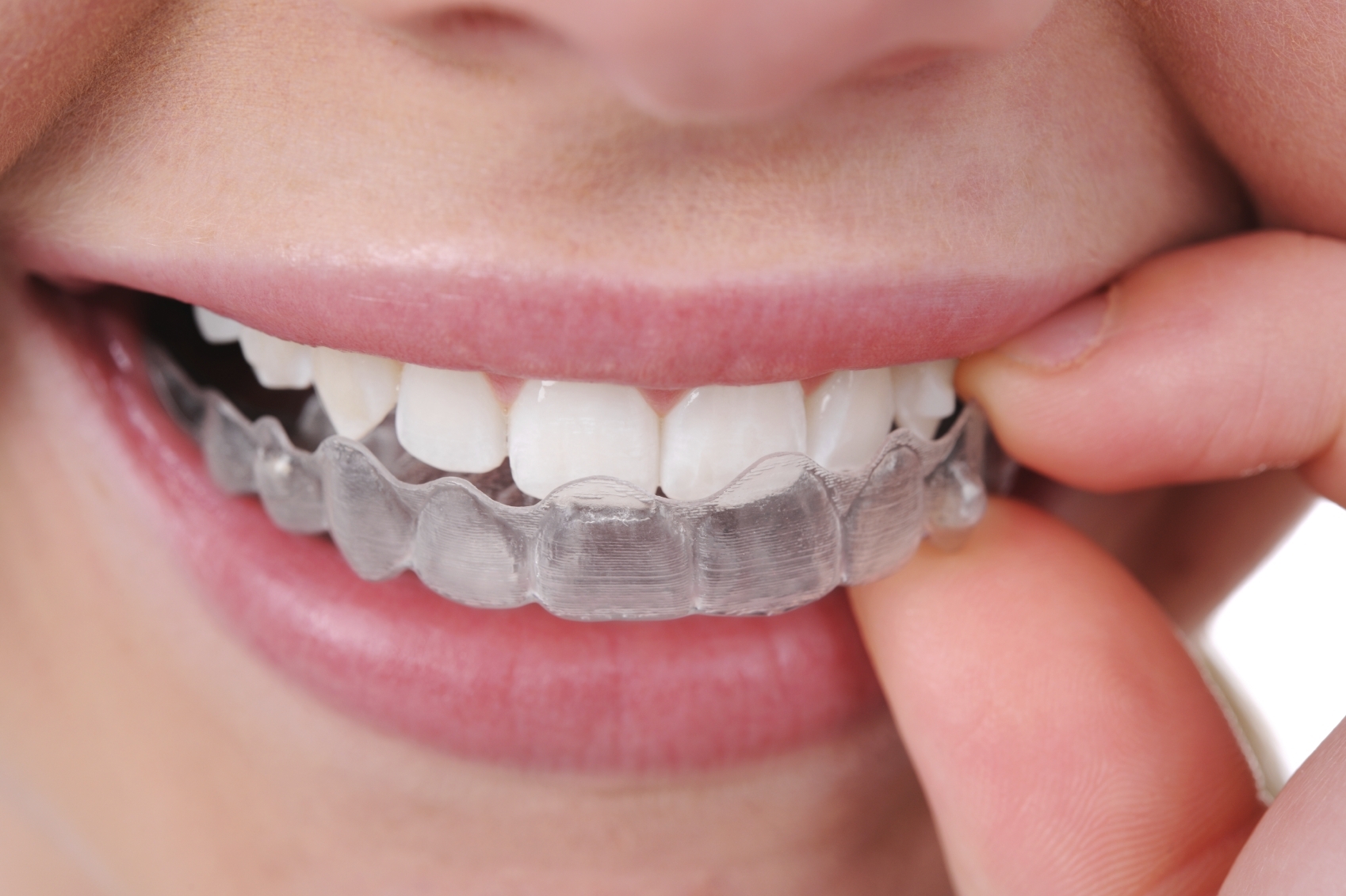 Invisalign: ortodonzia invisibile
