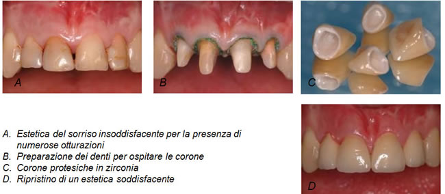 protesi-fissa-metalfree