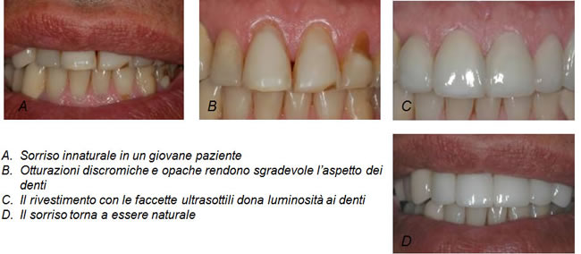 restiling-sorriso-faccettature