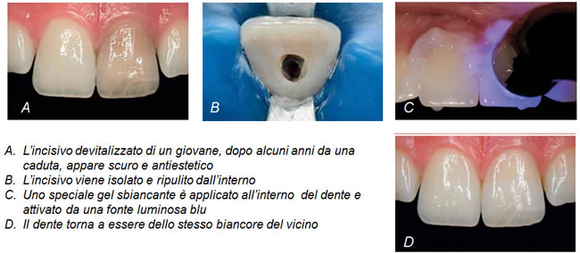 sbiancamento-interno