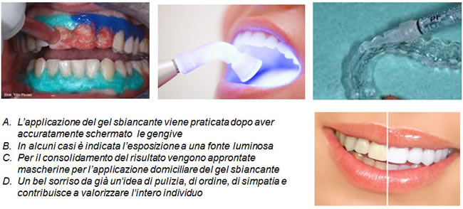 sbiancamento